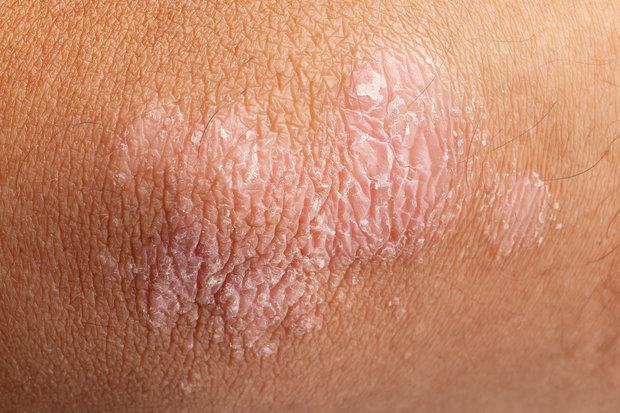 Psoriasis er en kronisk betennelse i huden